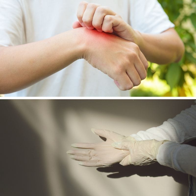 Person scratching itchy wrist, showing a latex allergy reaction. Gloves shown below.
