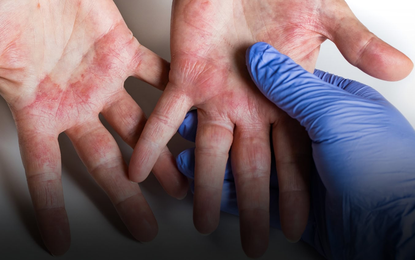 Potential allergic reactions to nitrile gloves Nitrile Gloves Info